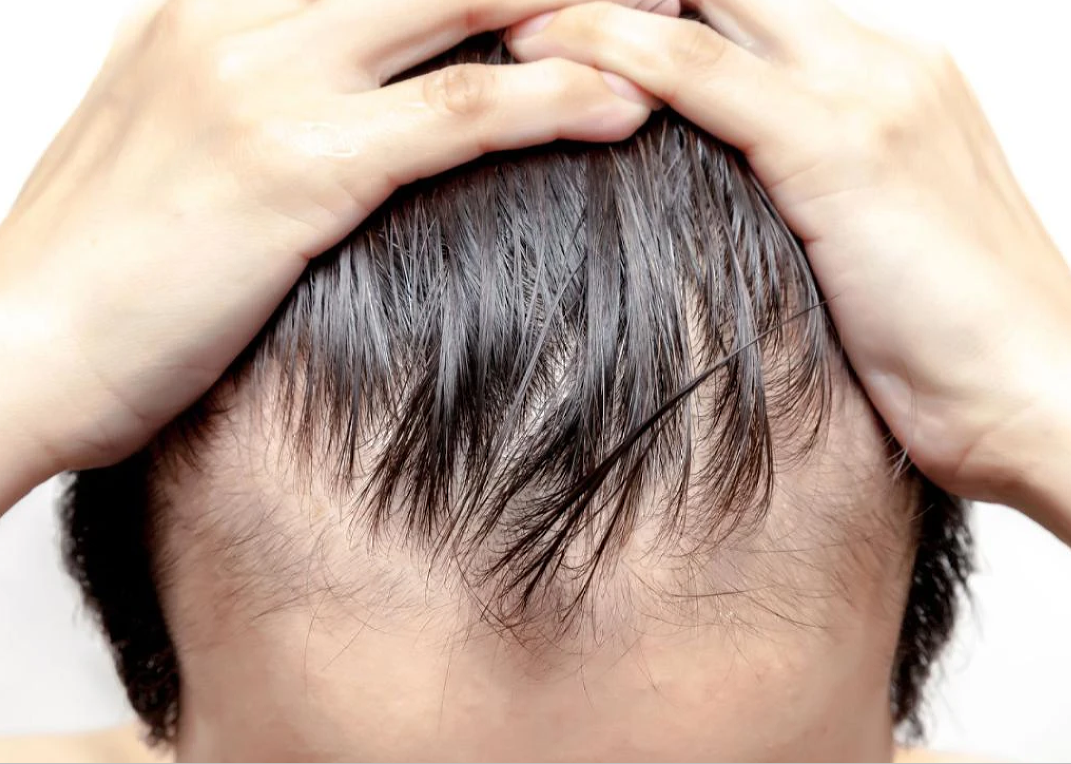Male Pattern Baldness Treatments – What’s Available?